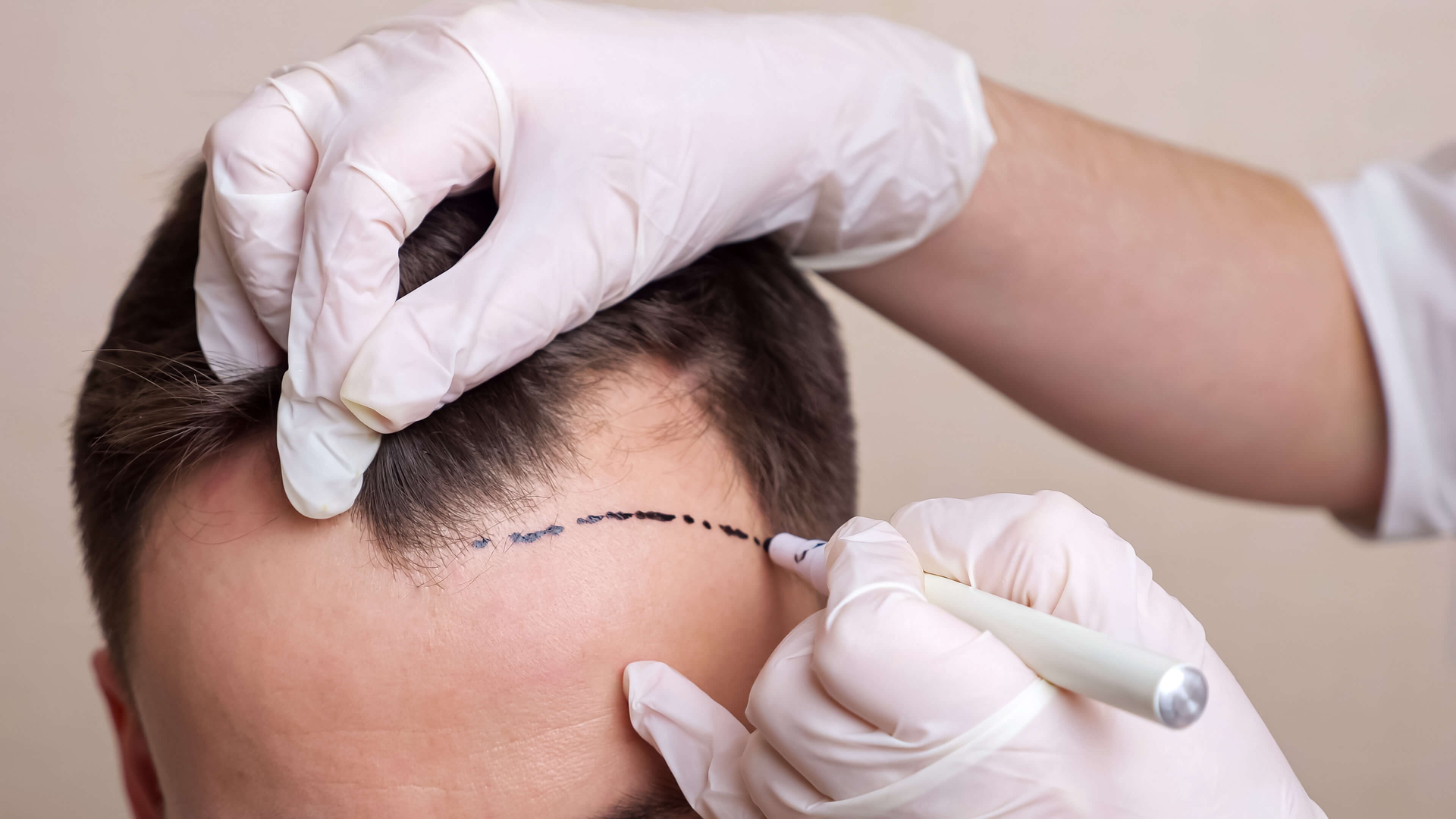 İstanbul Saç Ekimi – Live Hair Clinic